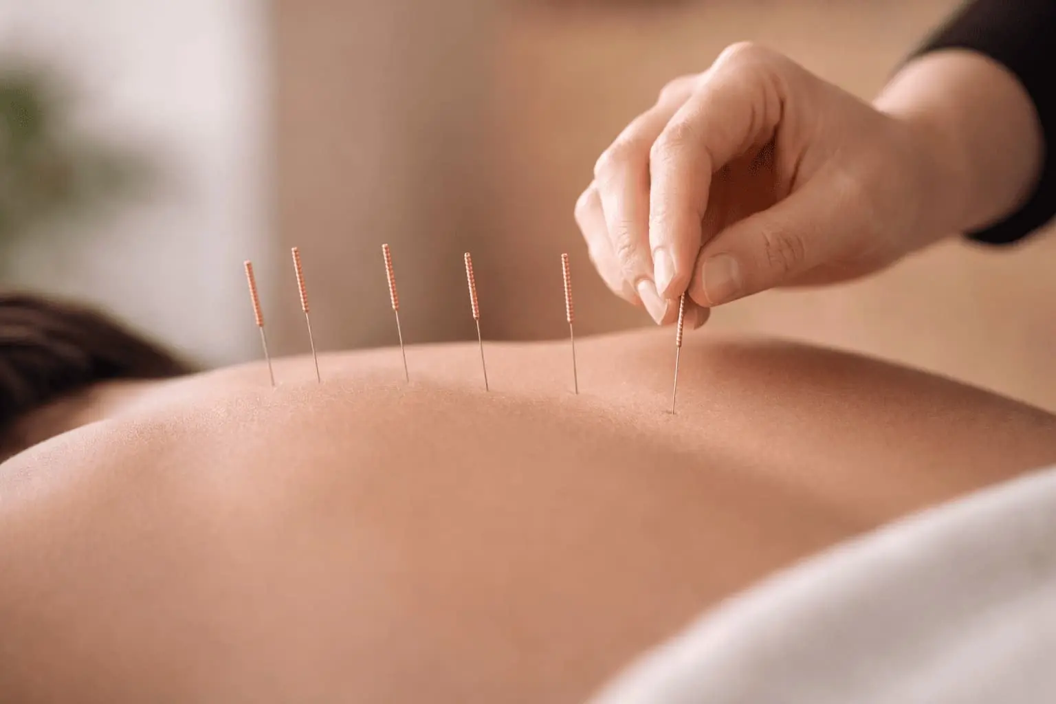 Acupuncture en entreprise