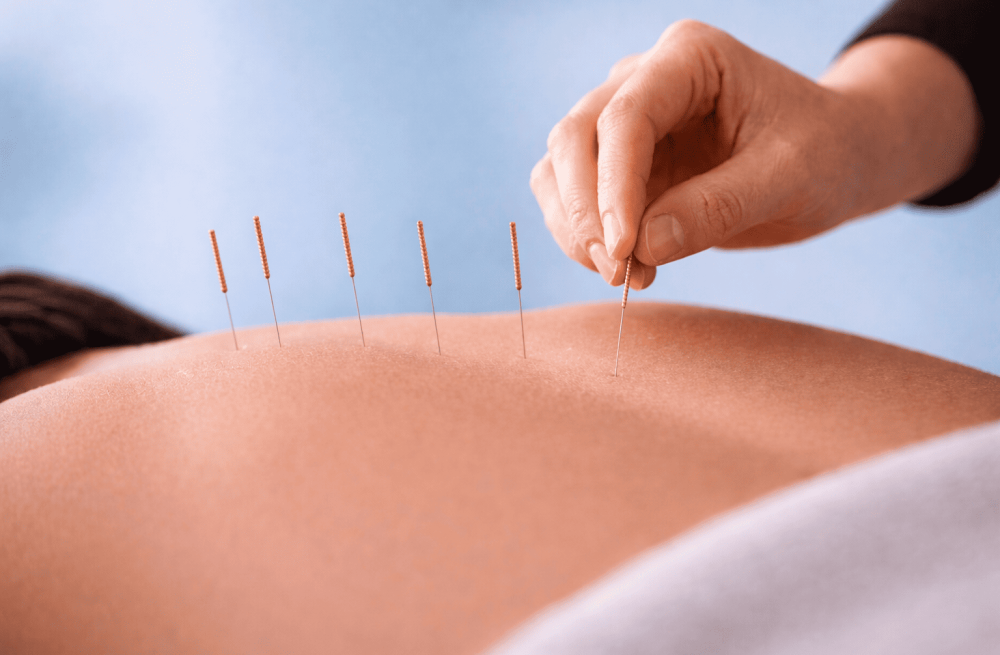 acupuncture entreprise